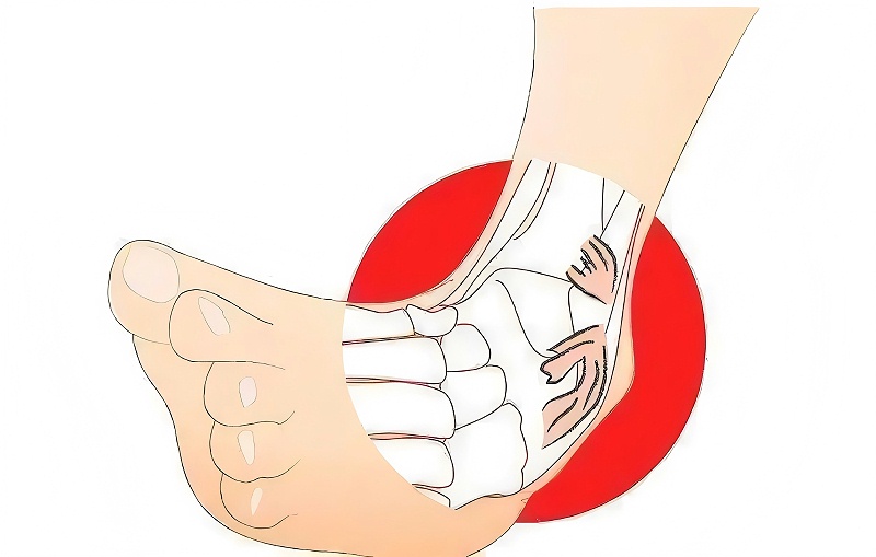 踝關節(jié)扭傷